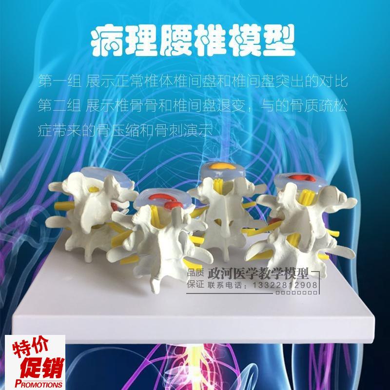教学仿真a病理脊椎模型四分型脊椎正常与bing变腰椎组合模型脊椎
