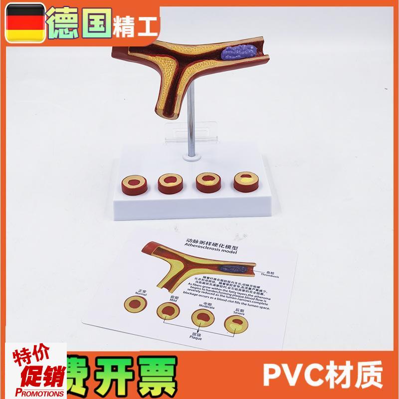 德国】动脉模型血栓o冠心血管解剖教学医药礼品健康管理教具医学