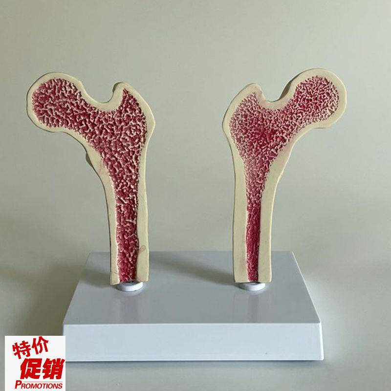 骨质疏松模型股骨头m骨髓密度变化骨科医药促销年龄段脊椎病理医