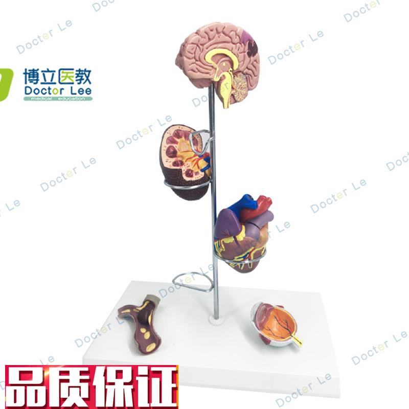 人体高血压模型高l血压大脑心脏血管内科普外科医生礼品大脑
