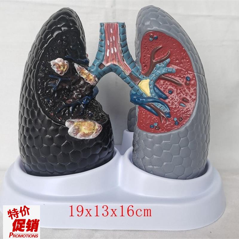 人体吸烟癌变肺模型健康t肺模型人类内脏吸烟肺与健康肺模型
