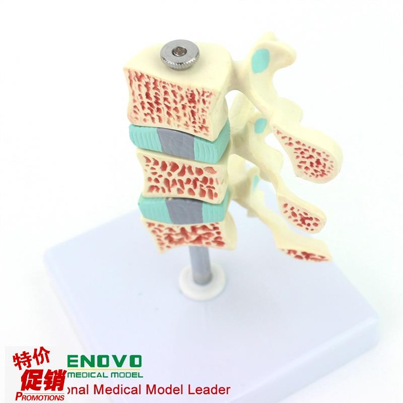 ENOVO颐诺人体骨质疏松症模型关D节骨质疏松模型人体椎间盘腰椎模