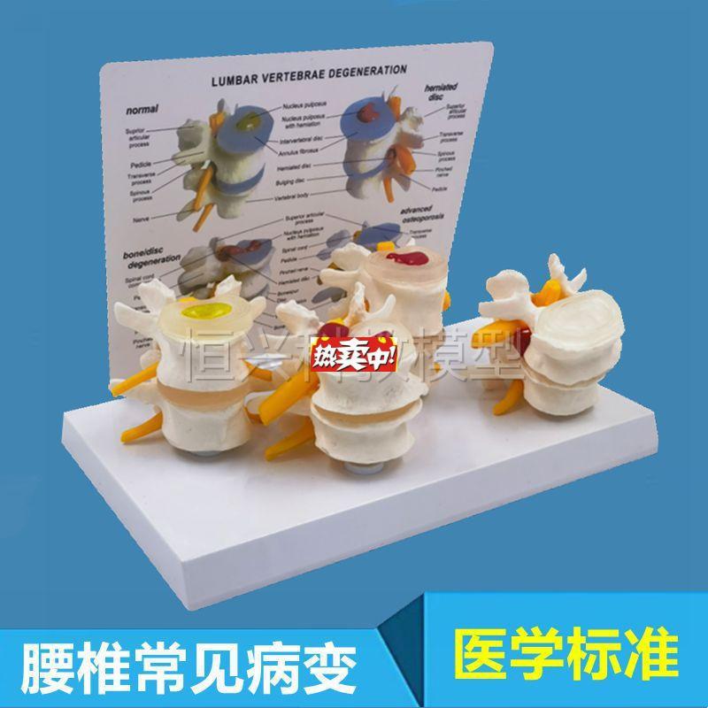 热销脊柱脊椎c结构小针刀骨科腰椎对比椎间盘突出脱出演示模