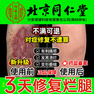 脉管炎老烂腿静脉曲张小腿烂脚溃烂专用修复膏伤口愈合祛去腐生肌