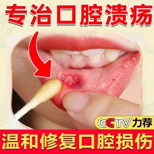 一点灵儿童壳聚糖口腔溃疡凝胶嘴巴上火起泡口疮喷雾剂药膏