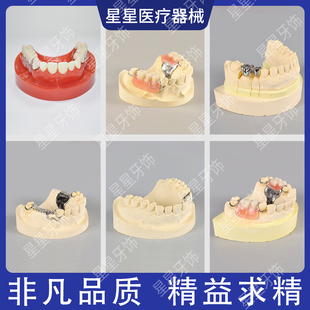牙科口腔种植模型铸造义齿模型马里兰桥制作步骤种植模型排牙模型