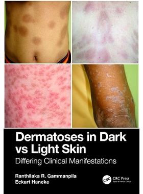 预订 Dermatoses in Dark Vs Light Skin: Differing Clinical Manifestations 深色皮肤与浅色皮肤的皮肤病：不同的临床表现: 978