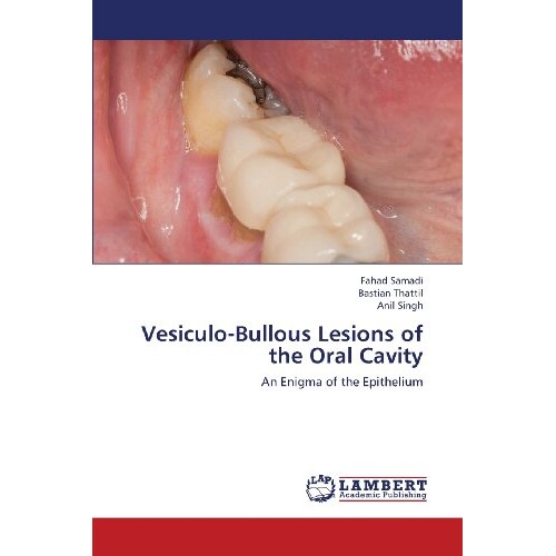 预订 Vesiculo-Bullous Lesions of the Oral Cavity: 9783659370502