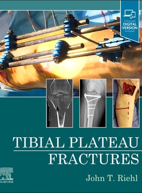 【预订】Tibial Plateau Fractures 9780323825689