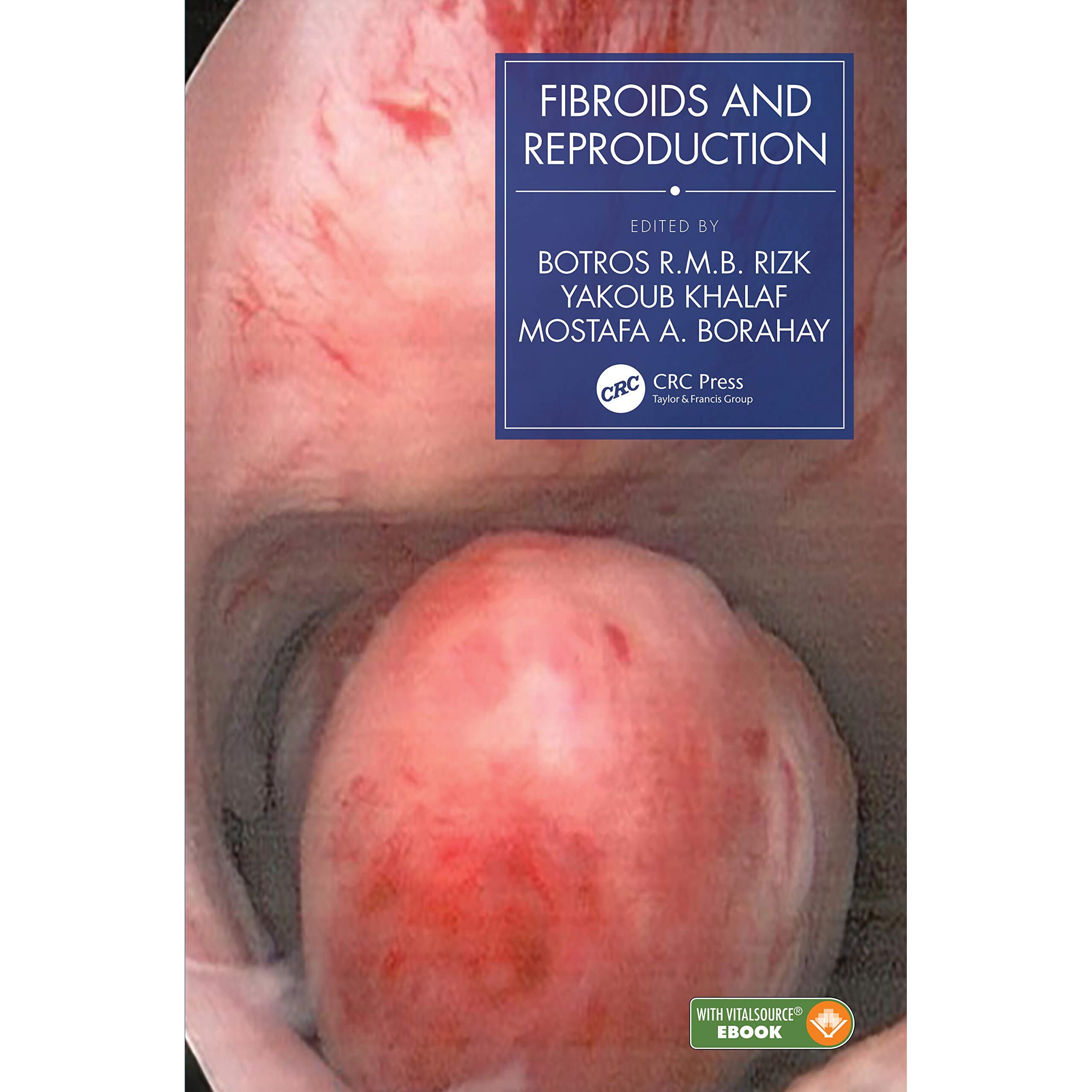 预订 Fibroids and Reproduction 肌瘤与生殖 9780367550677