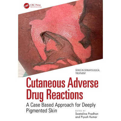 预订 Cutaneous Adverse Drug Reactions A Case Based Approach for Deeply Pigmented Skin 皮肤*不良反应：基于病例的深色皮肤