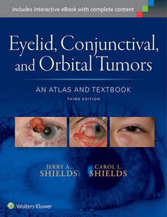 【预订】Eyelid; Conjunctival; and Orbital Tumors
