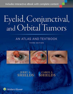 【预订】Eyelid; Conjunctival; and Orbital Tumors