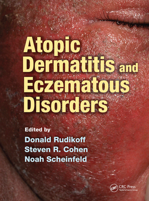 【预订】Atopic Dermatitis and Eczematous Disorders