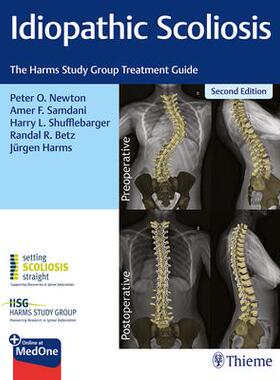 预订 []Idiopathic Scoliosis 9781684200559