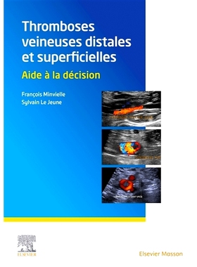 预订 Thromboses veineuses distales et superficielles : aide à la décision 远端和浅静脉血栓：决策支持: 9782294774652