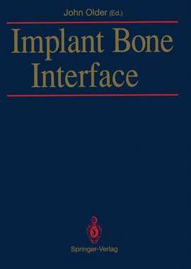 预订 Implant Bone Interface