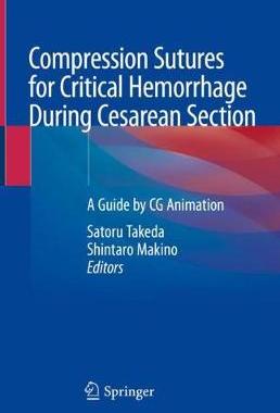 预订 Compression Sutures for Critical Hemorrhage During Cesarean Section