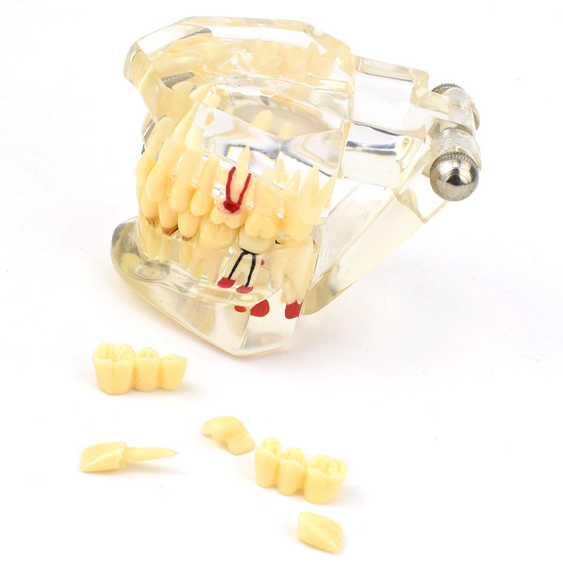口腔模型齿科种植阻生齿牙体牙髓口腔教学马里兰桥瓷贴