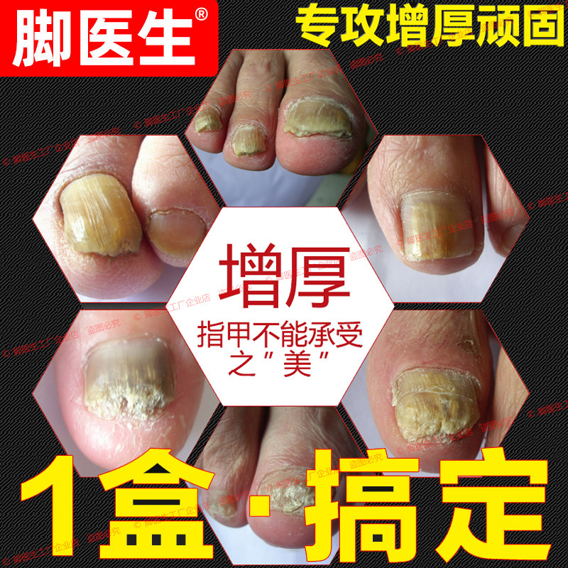 脚医生旗舰店正品甲卫士灰指甲专用非抑菌液甲沟指甲增厚修甲刀炎