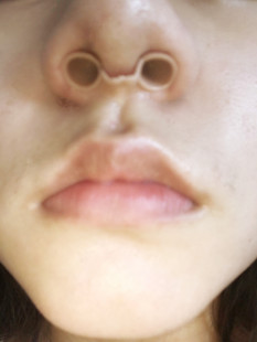 美国硅胶鼻模鼻撑/ 美鼻挺鼻/鼻中隔偏曲/鼻打鼾/兔唇/隆鼻术后