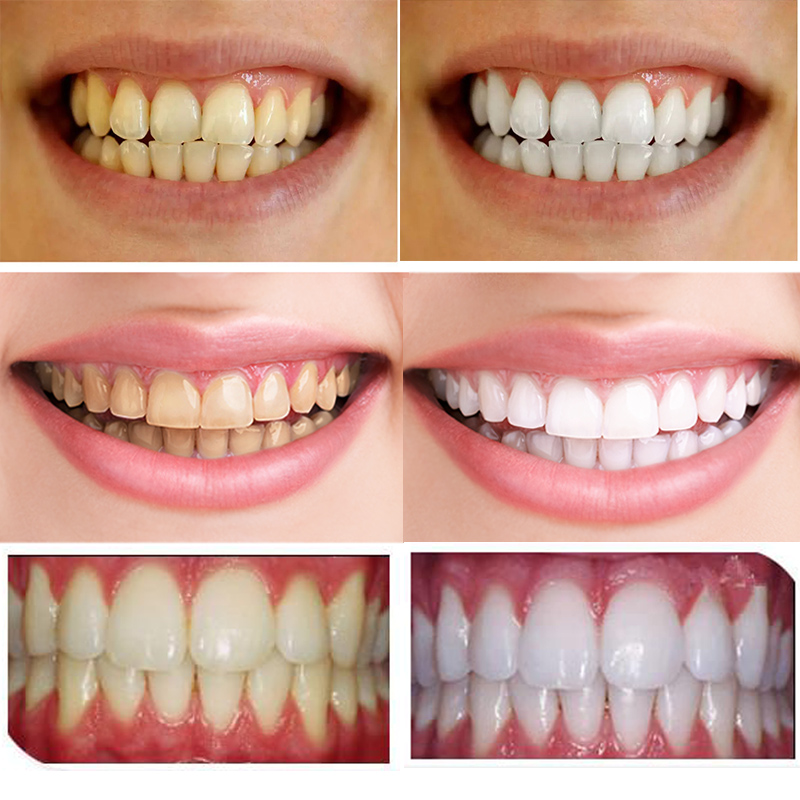 齿贝白白牙素正品包邮牙齿去黄牙洗牙牙结石去渍美白柠檬薄荷味