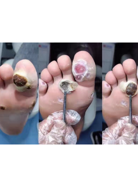 跖肉刺膏修脚店除足部趾茧净甲周血泡刺鸡茧膏贴无痛祛除老茧脚垫