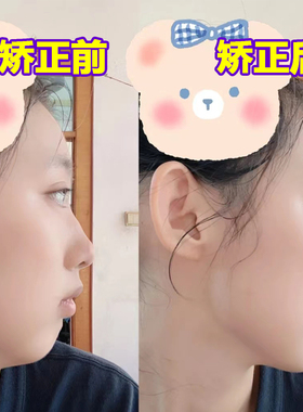 日本口呼吸唇肌训练成人儿童嘴突腺样体肥大面容矫正器睡觉防张嘴