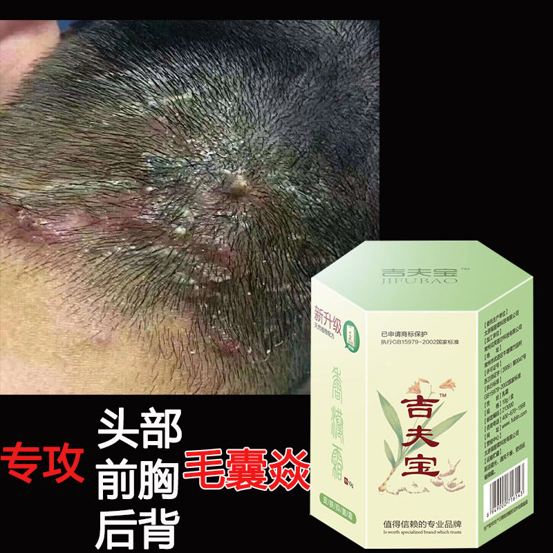 头皮面部长疙瘩疼前胸后背长红疙瘩小疙瘩去头屑正品吉夫宝