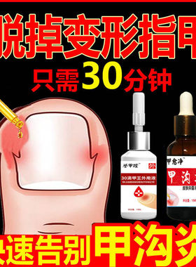 甲沟炎灰指甲脱甲软甲