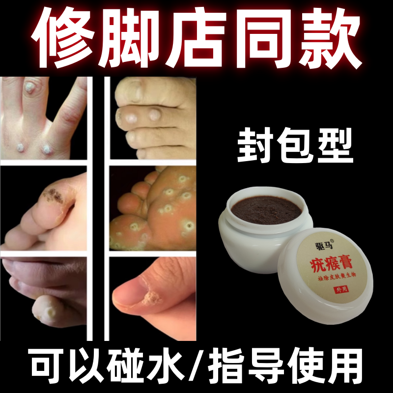 跖疣专用膏祛瘊子肉刺贴血胞刺去除鸡眼药刺猴茧子脚底寻常疣神器