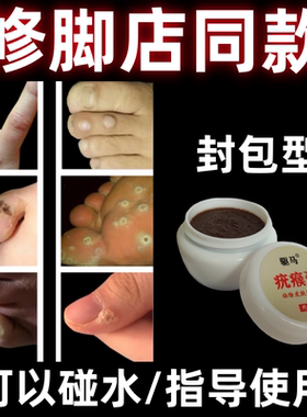 鸡眼跖疣去除足浴店封包型