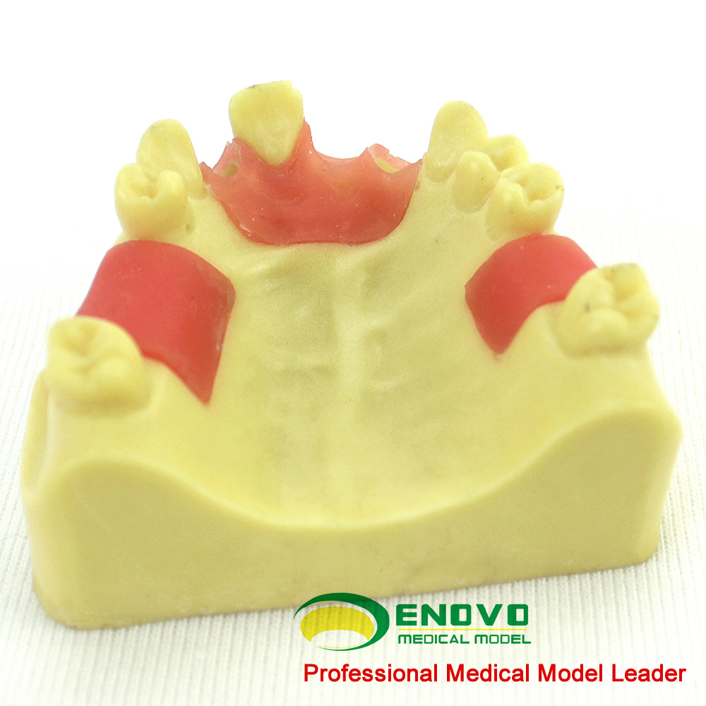 ENOVO颐诺上颌缺失种植实训模型 口腔即刻种植操作上颌骨缺失牙齿