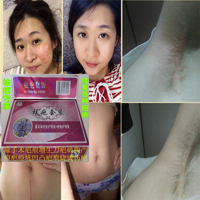 去疤痕凹凸疤修复膏去印刀疤美皮护激光手术剖腹产淡化妊娠纹损伤