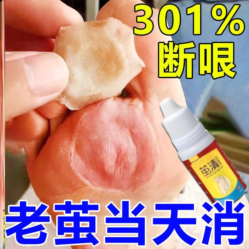 脚钉祛除膏去脚底根厚脚垫老茧鸡眼茧洁士胼胝贴硬死皮脚皮软化剂