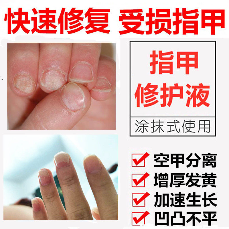 受伤指甲增厚甲肉分离空甲剥离症修复生长液竖纹凹凸不平开裂分层