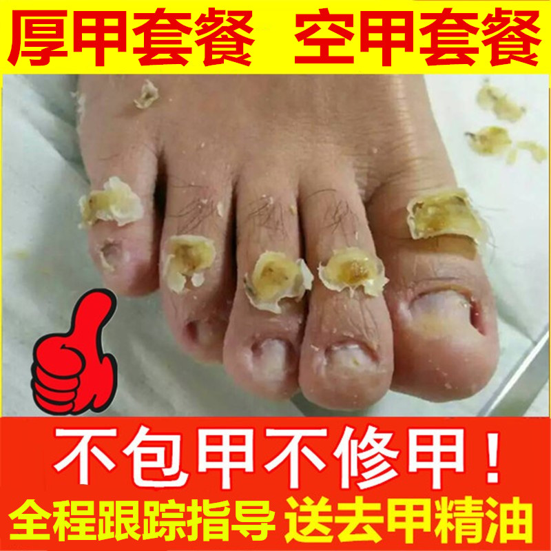 坏指甲增厚脚趾甲黄黑白空甲修复甲分离手指甲发黄变厚甲分层剥离