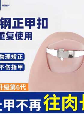 甲沟矫正器嵌甲矫正贴片卷曲甲脚趾甲往肉里长纠正专用正甲扣炎