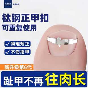 甲沟矫正器嵌甲矫正贴片卷曲甲脚趾甲往肉里长纠正专用正甲扣炎