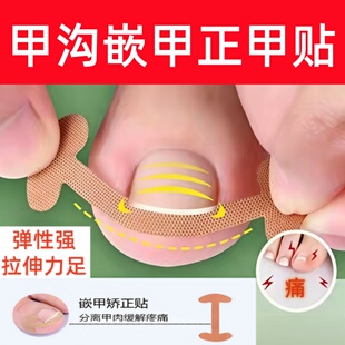 甲沟嵌甲贴片矫正正甲炎器脚趾甲防止长进肉里专用白色隔离垫片