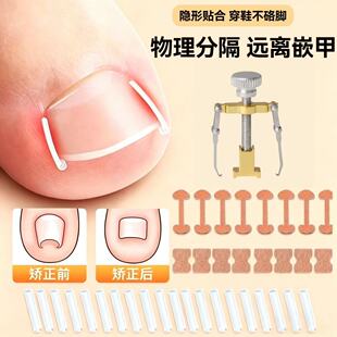 甲沟矫正器嵌甲贴片脚指甲往肉里长专用正甲贴炎指甲隔离垫
