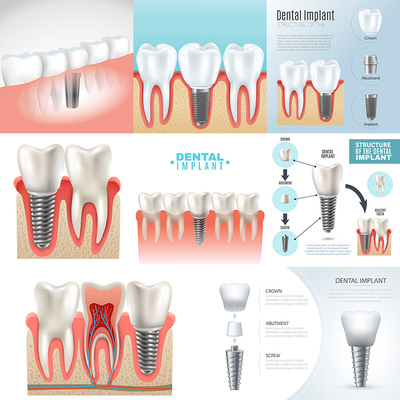 种植牙插画 牙科口腔牙齿缺失修复即刻种植体 AI格式矢量设计素材