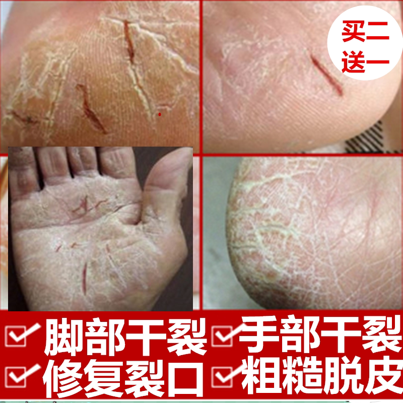 老人脚后跟干裂手足脱皮防裂膏皲裂治手脚龟裂开口愈合膏修复霜药