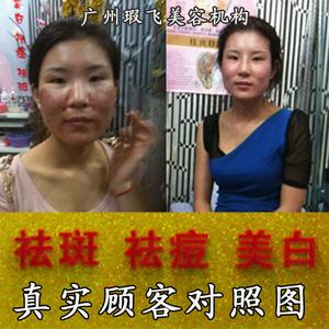 3号祛痘中草本去印醋疗面膜粉醋膜套装青春痘痘暗疮配日晚霜药膜