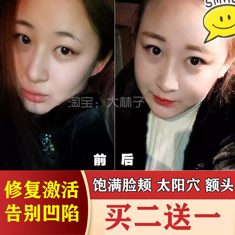 丰脸精华丰太阳穴额头苹果肌泪沟法令纹下巴饱满脸部脂肪填充凹陷