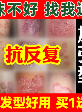湿止痒疹去顽固根专用慢性皮炎皮肤瘙痒外用膏干燥全身痒抑菌膏
