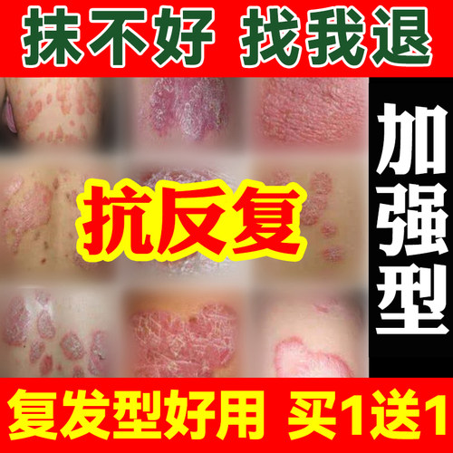 各种湿痒疹皮专用特效膏