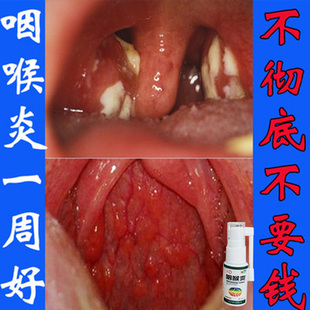 治治疗咽喉炎慢性咽炎喷剂神器异物感止咳化痰茶特效蜂胶雾化喷雾