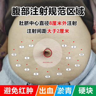 低分子肝素孕妇腹部肚脐部位皮下轮换注射定位辅助对照卡设备器