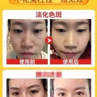 雀斑提取液老年表皮斑生物酶提取液点斑水水解酶无痛款美容院